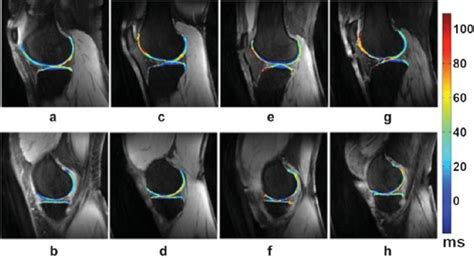 Representative T1μ Maps Of Femorotibial Cartilage In The Lateral A C