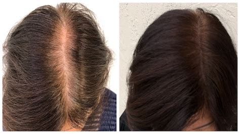 Thinning hair and hair loss: Solutions for Women - Hairline Studios