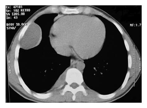Chest X Ray Image Of The Extrapulmonary Intrathoracic Hydatid Cyst In