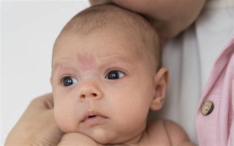 Baby Acne Causes And Treatments Infant Guides