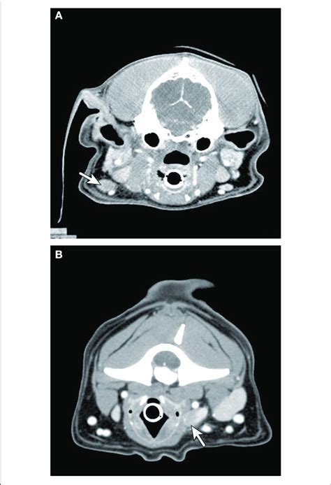 Axial Ct Imaging Of Metastatic Neck Lymph Nodes Associated With