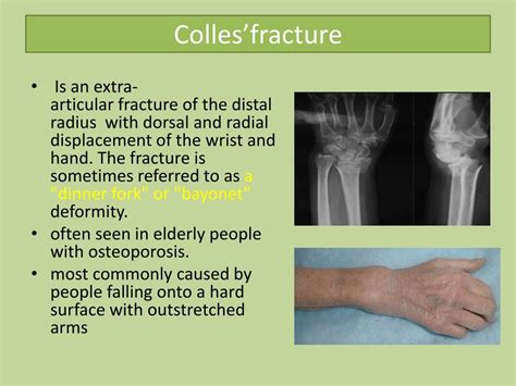 Ppt Common Upper Limb Fractures Powerpoint Presentation Free The Best