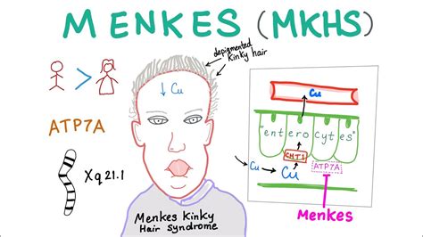 Learn More About Menkes Mia