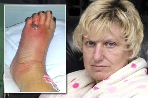 False Widow Spider Ate My Foot And Experts Warn Of More Attacks Daily Star