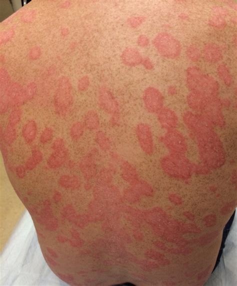 Diffuse Erythematous Scaly Eruption Aafp