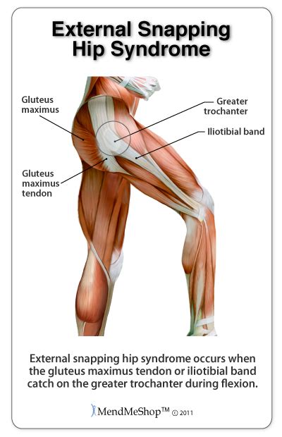 Place/hold digital flexion with wrist extended in hook, straight and full fist positions. Hip Flexor Strain-Tear
