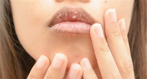 Common Causes Of Dry And Flaky Lips That You Should Know