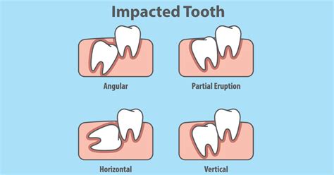 Do I Need To Remove An Impacted Wisdom Tooth If It Is Not Causing Any