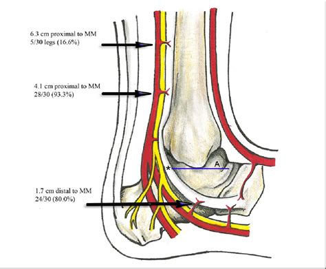 Figure 2 From Arterial Anatomy Of The Tibialis Posterior Tendon
