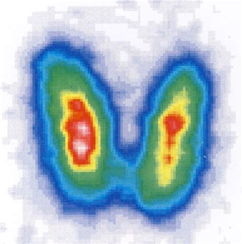 Ein knoten an der schilddrüse ist schwierig. Schilddrüsendiagnostik » Radiologie Darmstadt