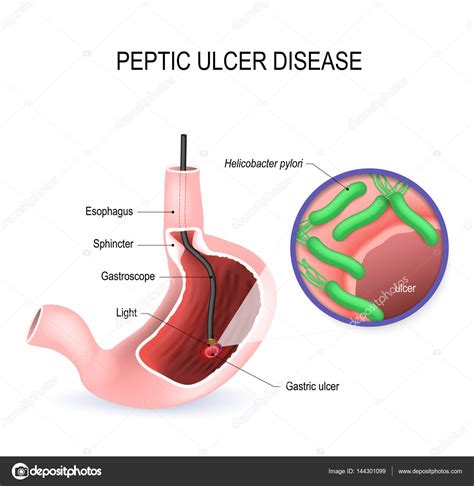 Stomach cancer often is not diagnosed until the later what is a stomach (peptic) ulcer? Peptic ulcer disease (PUD), stomach ulcer or gastric ulcer ...