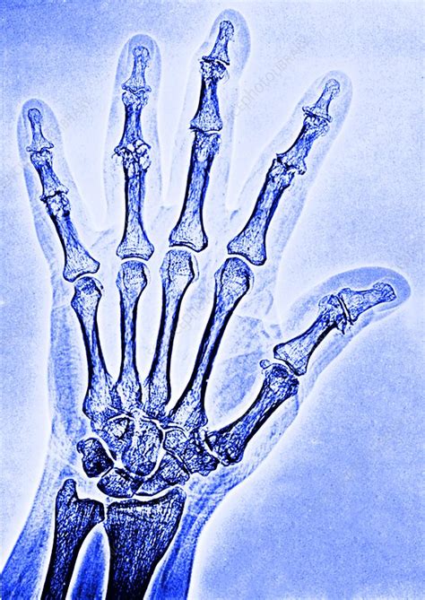 Arthritic Hand Bones Stock Image M1100529 Science Photo Library