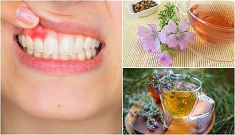 5 Natural Home Remedies For Gingivitis Step To Health