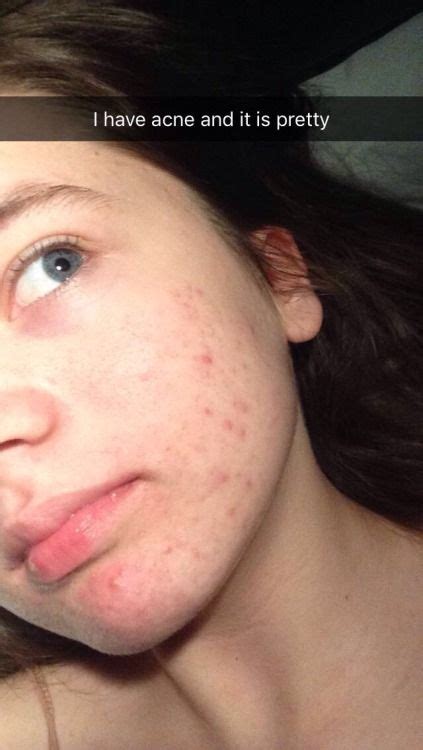Pin On Acne Doesnt Make You Ugly