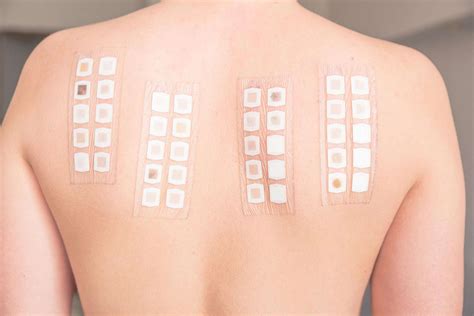 Patch Testing For Allergies Harley Street Dermatology Clinic