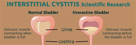 Symptoms Of Cystitis Bladder