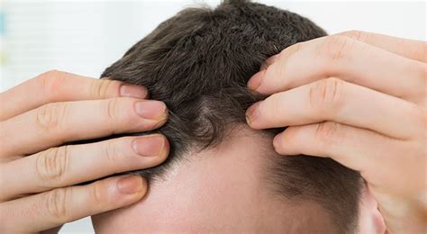 Dermatite seborroica e alopecia: c'è un legame? | Aluseb ...