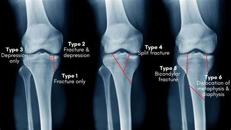 Tibial Plateau Fracture Classification And Treatment