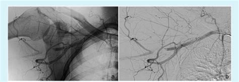 Angiogram Images Demonstrating The Axillary Artery Occlusion
