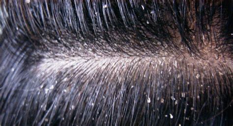 Winter and hair are not usually friends! Dry Scalp Treatments | Dry Itchy Flaky Scalp Treatments ...