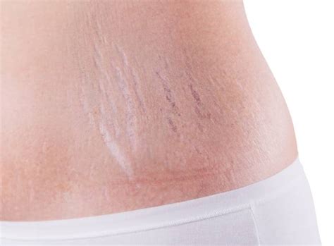 Stretch Mark Removal Clinic In Hyderabad Stretch Marks Treatment