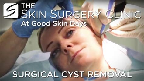 Cyst Removal From £395 Leeds Bradford Skin Surgery Clinic