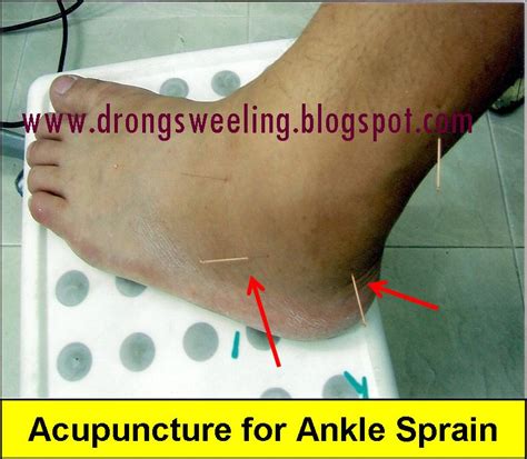 Tcm News Tcm Clinic Physician Treat Sprain Ankles Wrists Knee Injuries