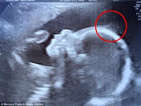 Ärzte Bemerkten Seltsame Konturen Im Ultraschallbild Des Babys Jetzt