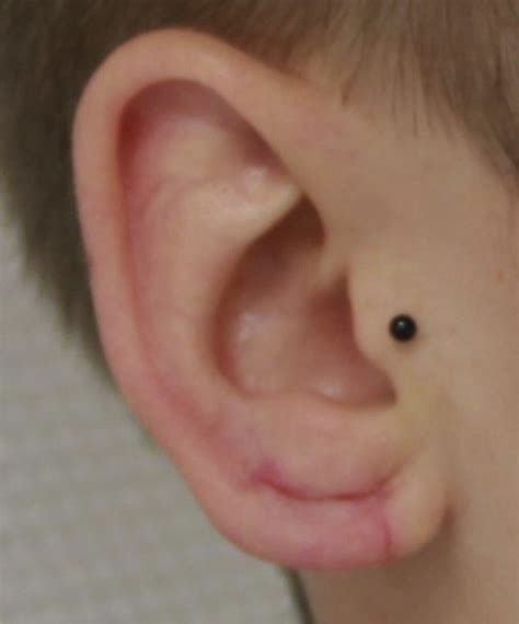 Reconstruction Of The Earlobe While Preserving Its Volume Following