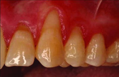 A Pre Operative Image Of Significant Gingival Recession Defects About