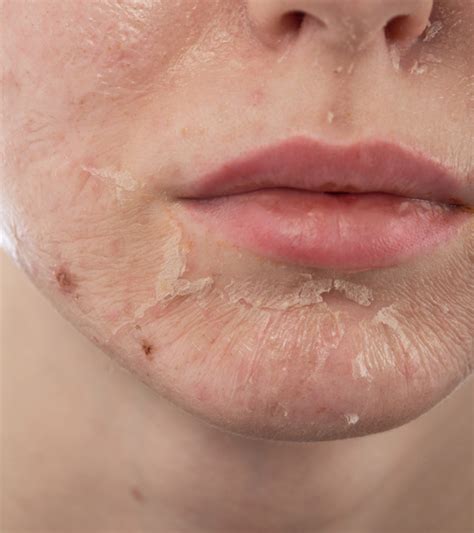 Skin Peeling Causes Symptoms And How To Reduce It