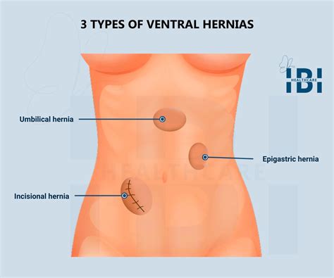 Laparoscopic Ventral Hernia Repair Ibi Healthcare Institute