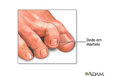 einfallen Alaska Konsistent síndrome do dedo do pé em martelo Hintergrund Dreh dich um Spende