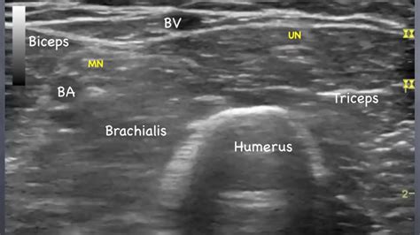 Median Nerve Elbow Sonoanatomy Qmh Aed Ultrasound Casebook 2013
