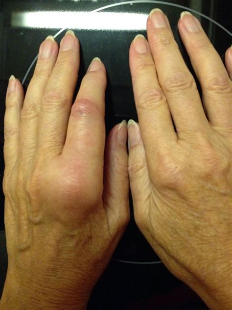 Mariettes Back To Basics My Hand With Dupuytrens Contracture Update