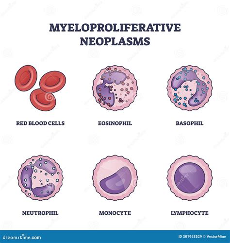 Myeloproliferative Neoplasms As Bone Marrow Blood Diseases Outline