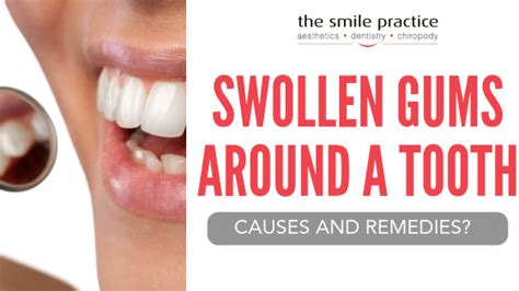 Swollen Gums Around A Tooth Causes And Remedies The Smile Practice