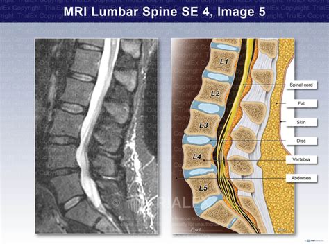 Mri Lumbar Spine Trial Exhibits Inc