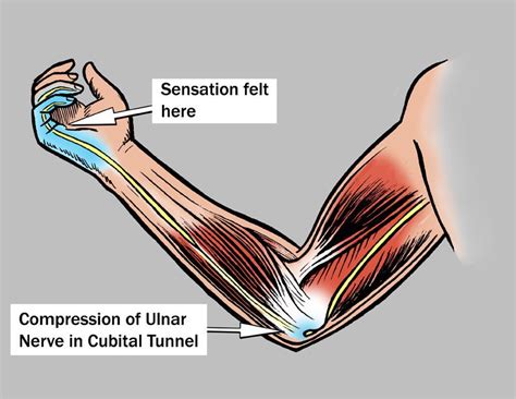 Cubital Tunnel Syndrome Causessymptomsdiagnosis And Treatment How