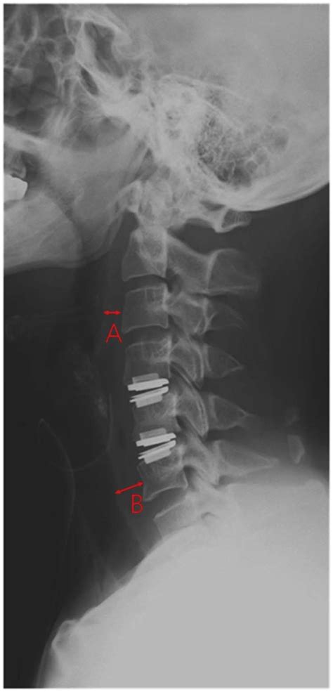 The Natural Course Of Prevertebral Soft Tissue Swelling After Anterior