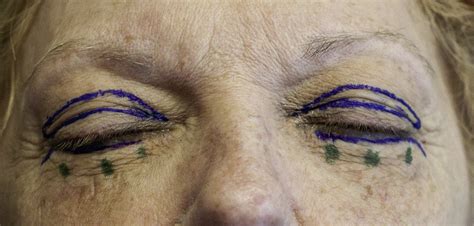 Lower Transcutaneous Blepharoplasty Atlas Of The Oral And