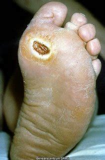 Infeksi kurap pada tangan terjadi ketika jamur menginfeksi kulit. Jenis-Jenis Penyakit Kulit - Foto Unik