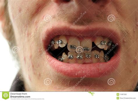 Close Up Of Crooked Teeth With Braces Stock Photography