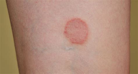Ringworm In Children Ages One To Five Babycentre Uk