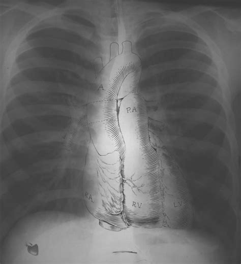 Normal Chest X Ray Litfl Medical Blog Labelled Radiology X Ray