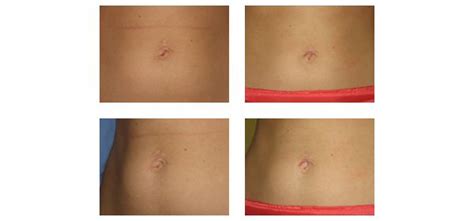 Belly Button Surgery Photos Plastic Surgeon Surgery Belly Button