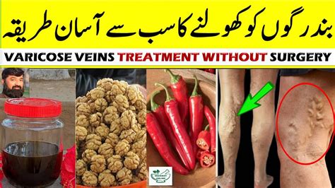 Varicose Veins Treatment Without Surgery Band Naso Ko Kholne Ka Tarika Remedies For Blocked