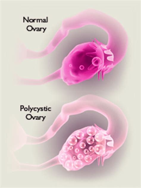 POLYCYSTIC OVARY SYNDROME PCOS OVERVIEW OF SYMPTOMS AND CAUSES Rocky Mountain Fertility
