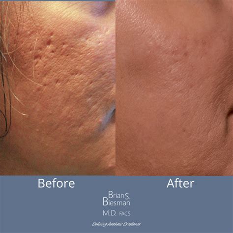 Scar Treatment Before And After Brian S Biesman Md