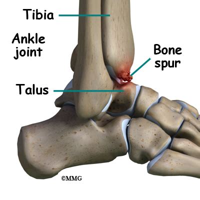 A bone spur is a boney projection along a normal bone. Ankle Arthroscopy | eOrthopod.com